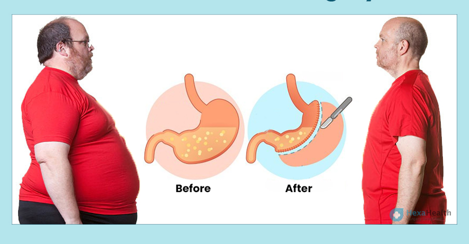 Apasih Bariatric Surgery Itu? Bukan Sekadar "Operasi Langsing"!