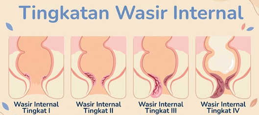 Ambeien? Kapan Harus Segera ke Dokter?